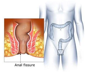 Fissures Dr.Tathed s Homeopathy