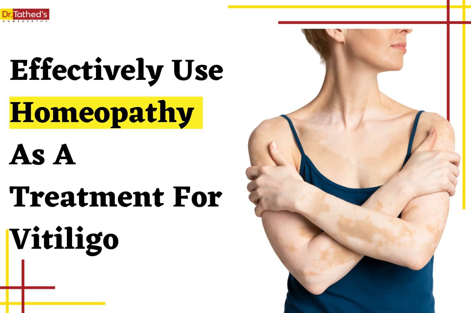 How To Effectively Use Homeopathy As A Treatment For Vitiligo
