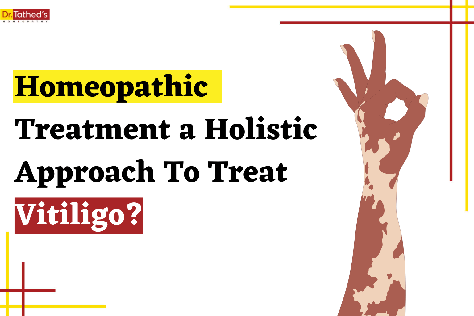 ATTACHMENT DETAILS Why-Is-Homeopathic-Treatment-A-Holistic-Approach-To-Treat-Vitiligo