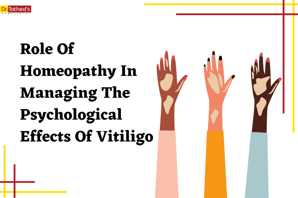 The Role Of Homeopathy In Managing The Psychological Effects Of Vitiligo