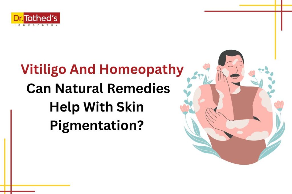 Vitiligo And Homeopathy