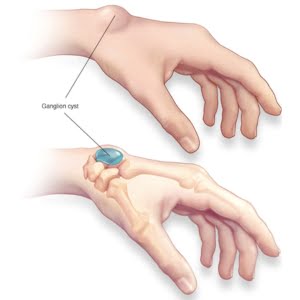 Ganglion Cyst Homeopathic Treatment