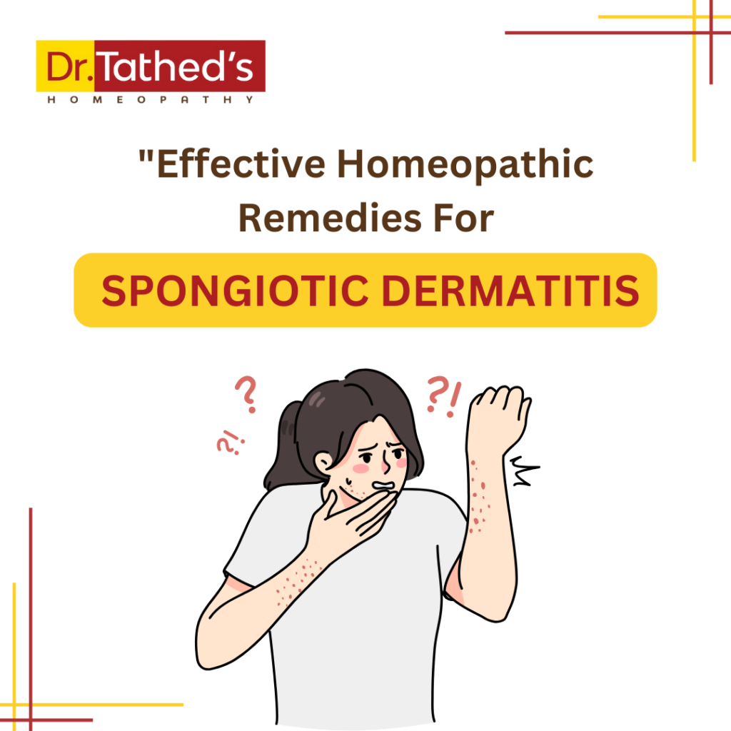 Homeopathic Remedies for Spongiotic Dermatitis - Dr.Tathed's Homeopathy