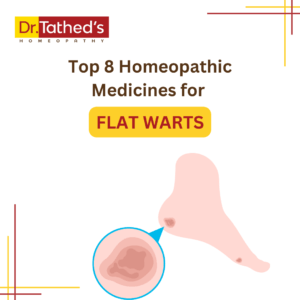 Top 8 Homeopathic Medicines for Flat Warts