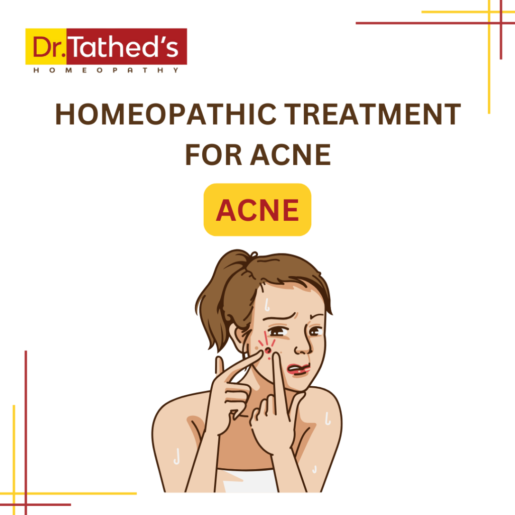 Homeopathic Treatment for Acne