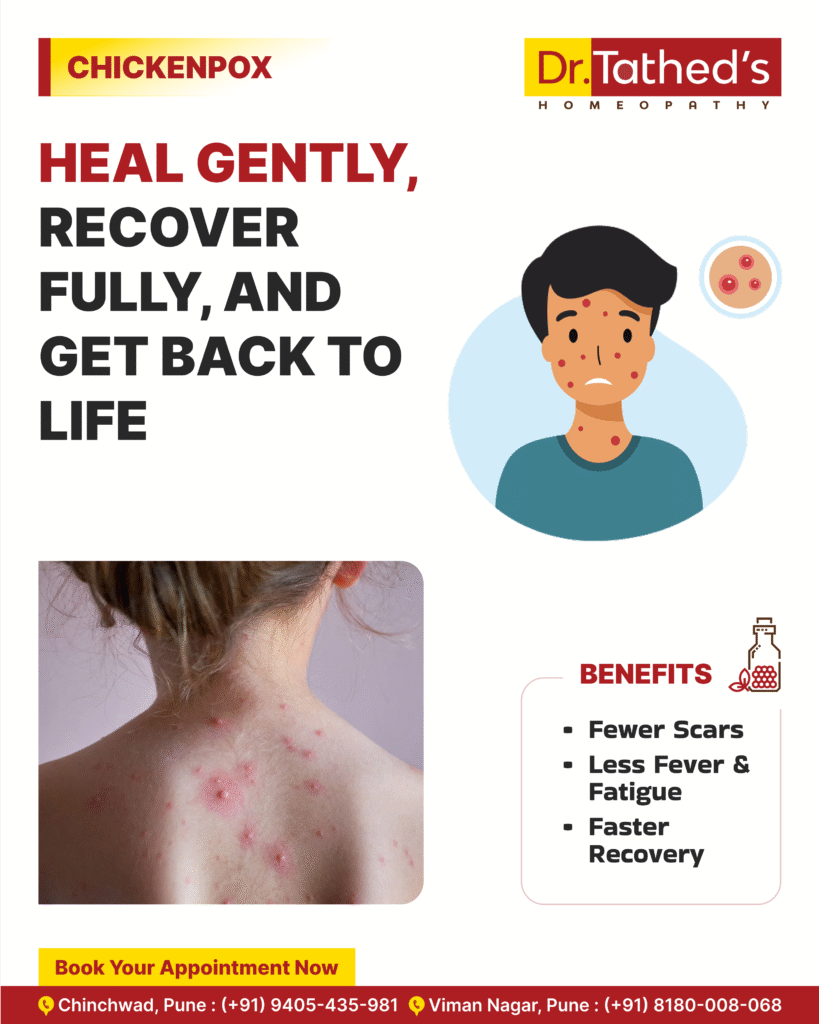 Chickenpox Recovery the Natural Way with Homeopathy