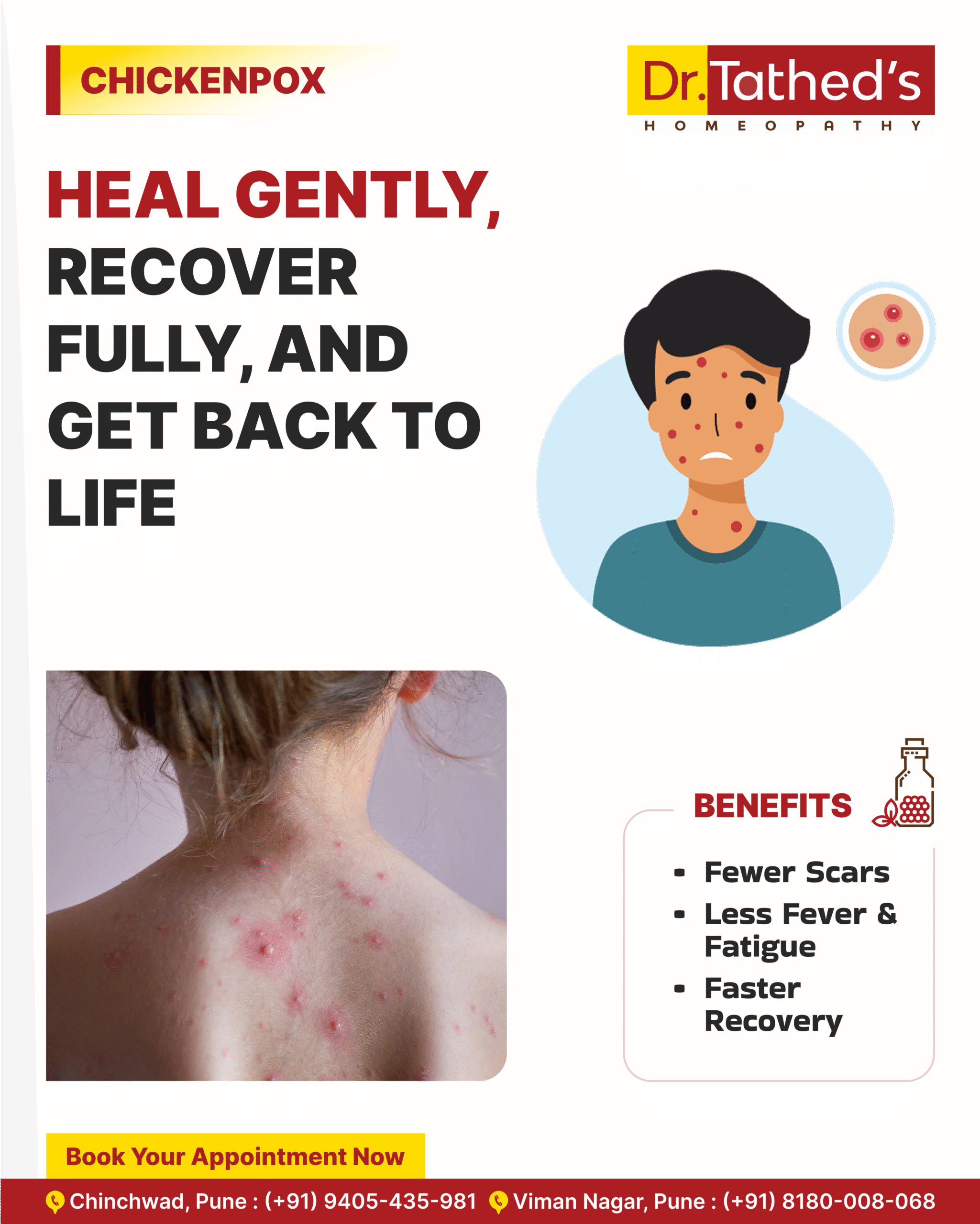 Blogs 2 Chickenpox Recovery the Natural Way with Homeopathy