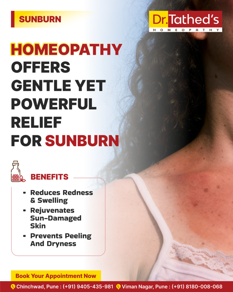 Best Homeopathic Remedies for Sunburn