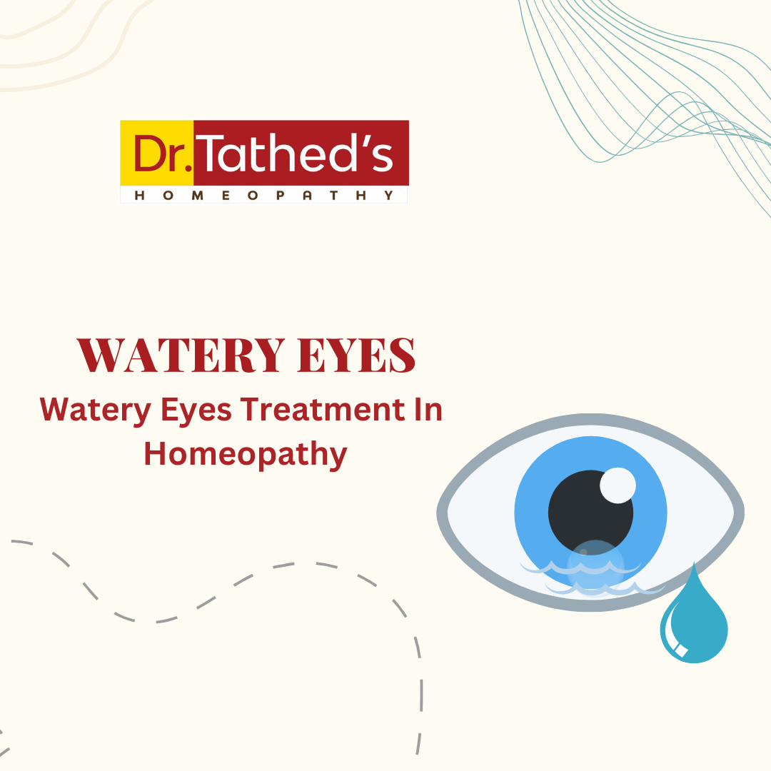Homeopathy Doctor in Viman Nagar 12 Homeopathy for Watery Eyes