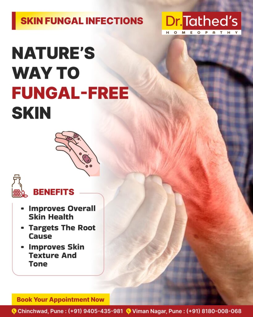 Homeopathic Remedies for Fungal Infections : Safe, Natural, and Effective Solutions