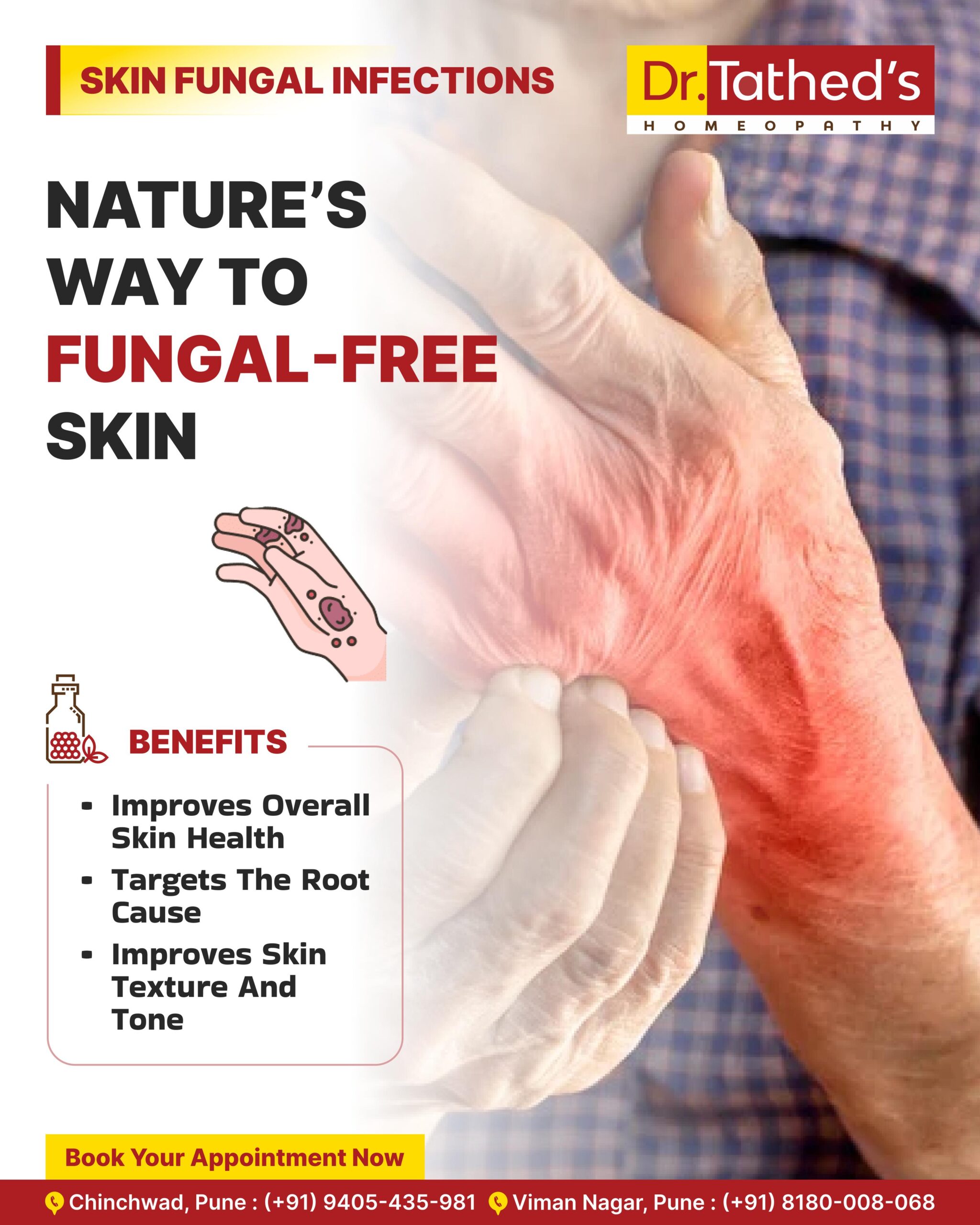 Homeopathy Doctor in Viman Nagar 10 Homeopathic Remedies for Fungal Infections : Safe, Natural, and Effective Solutions