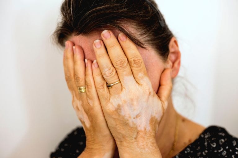Home | Vitiligo Treatment Pune & PCMC